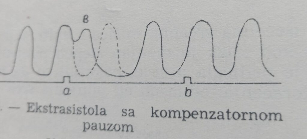 ekstrasistola sa komperzatornom pauzom