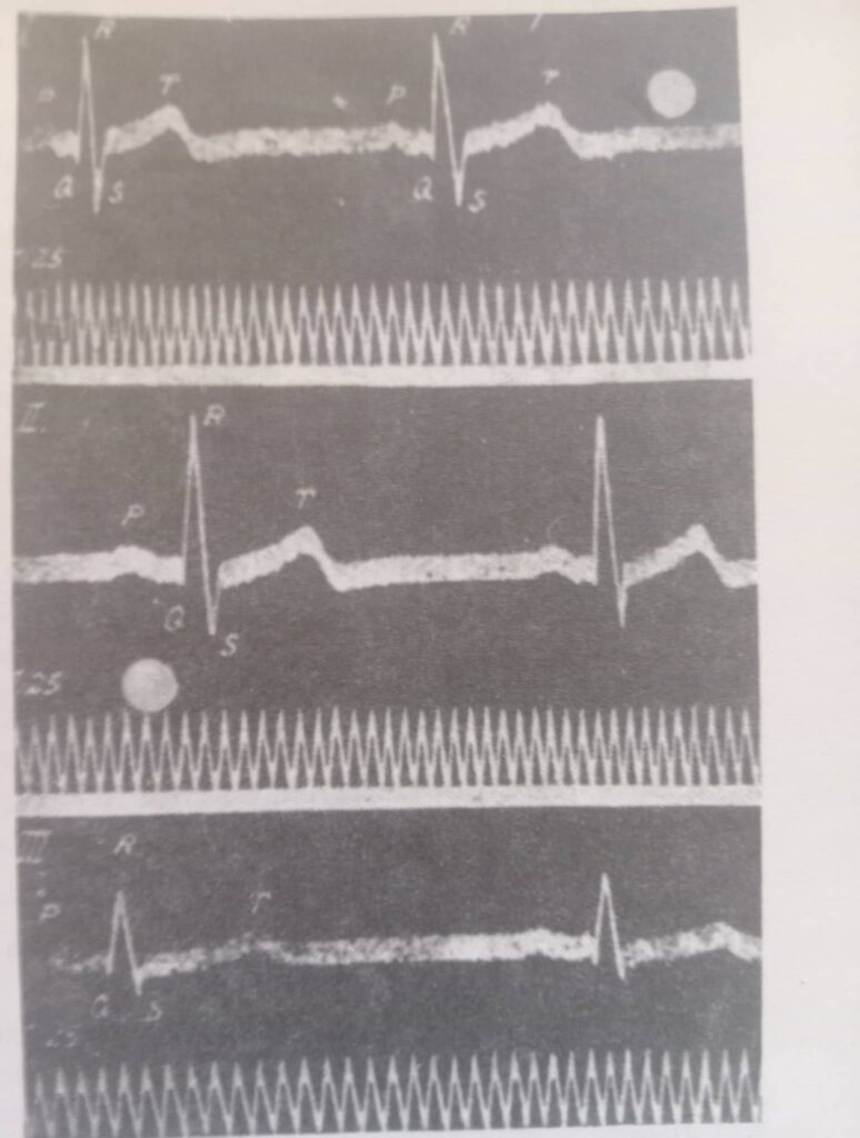 elektrokardiogram EKG coveka u tri standardna odvoda 